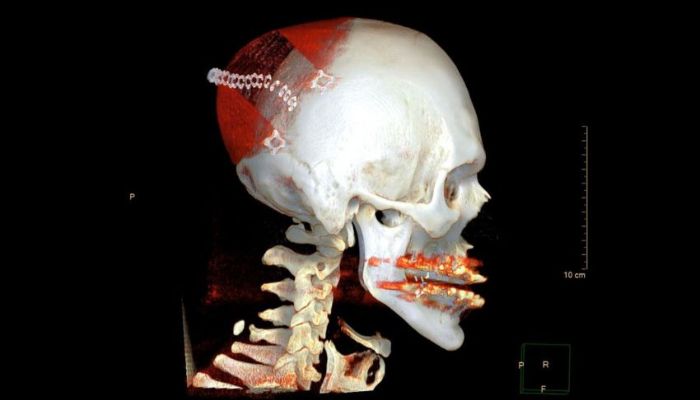 In the future, larger implants, such as those used to reconstruct the skull, could be made using a bone implant from the 3D printer