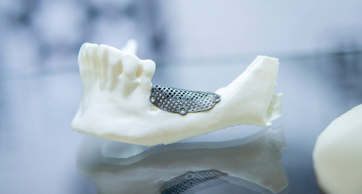 Traditional titanium meshes used in jaw surgery provide strength, but a novel plastic mesh may lead to better surgical outcomes.