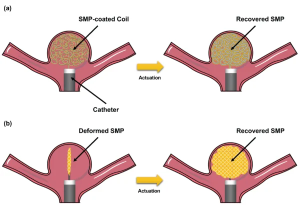 Schematic of two potential approaches to fabricate shape memory polymer (SMP)-based endovascular devices for ICA treatment: (a) SMP-coated coils; and (b) SMP coil-free foams with patient-specific geometries. Courtesy of Shape Memory Polymer-Based Endovascular Devices: Design Criteria and Future Perspective