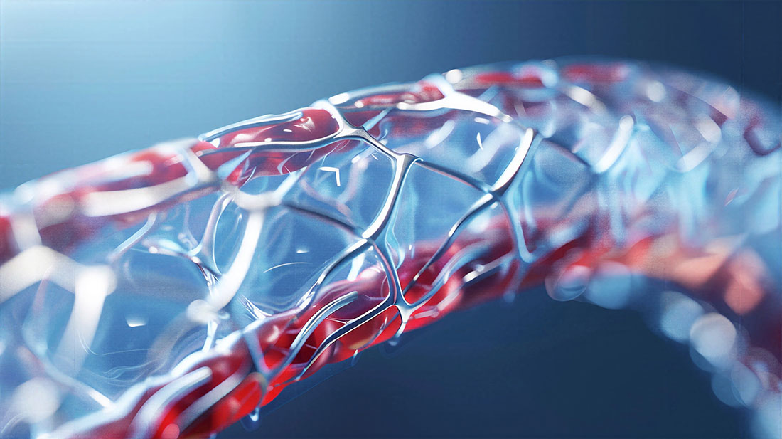 Shape memory polymers expand inside aneurysms using body heat, helping fill structural gaps that can lead to recurrence.